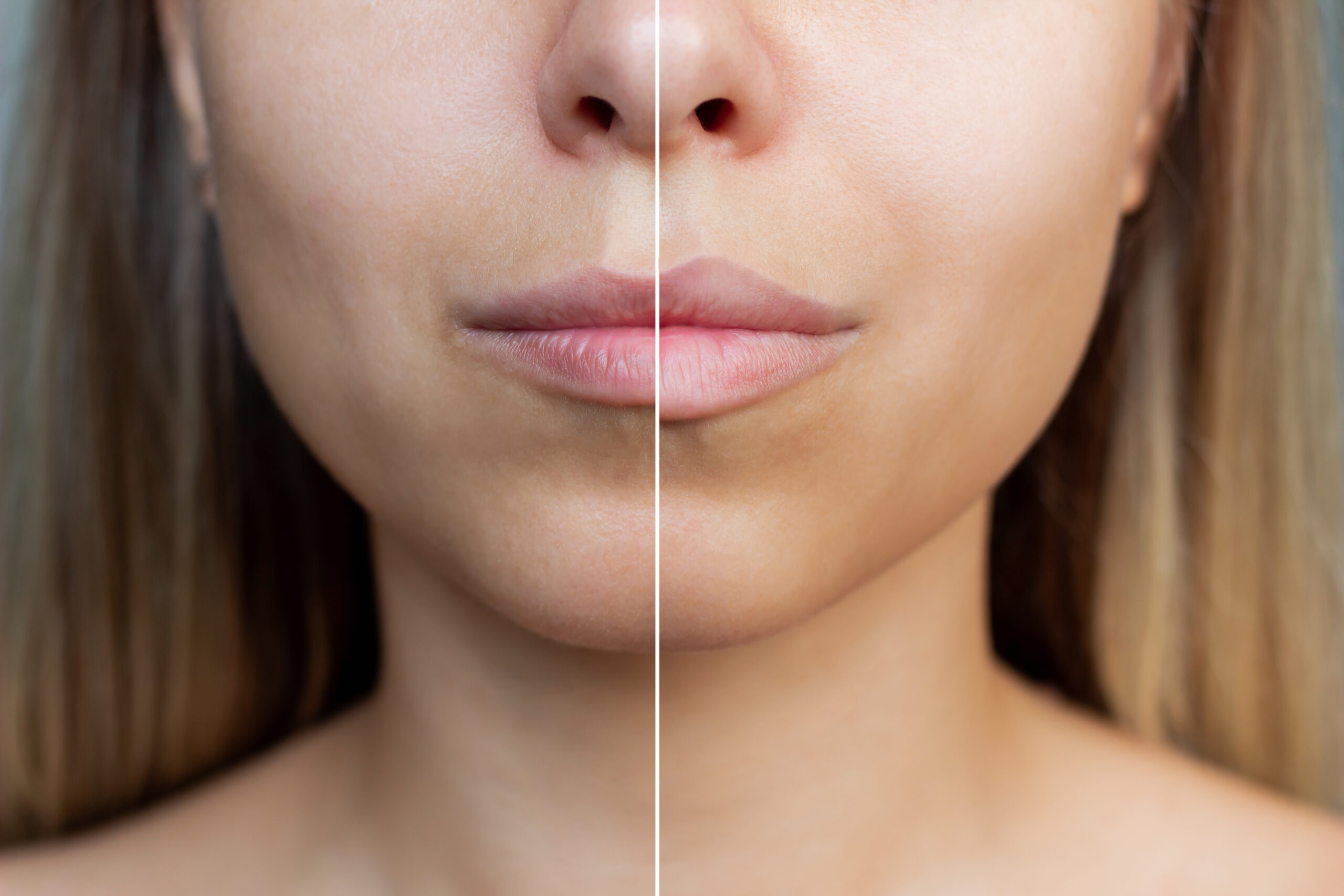 before and after lip filler